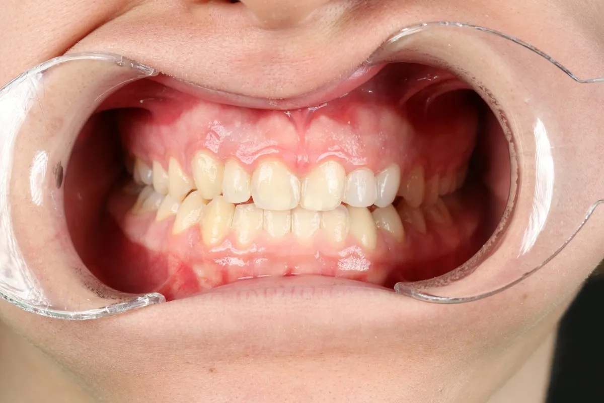 Front teeth in crossbite, corrected without surgery: front view after treatment