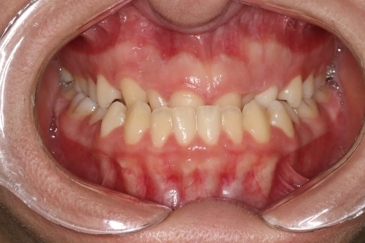 Front teeth in crossbite, corrected without surgery: front view before treatment