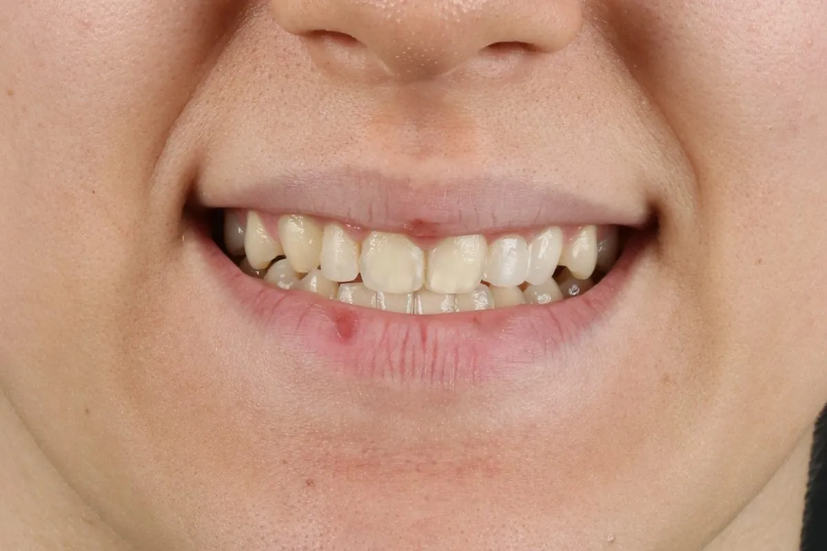 Front teeth in crossbite, corrected without surgery: smile after treatment