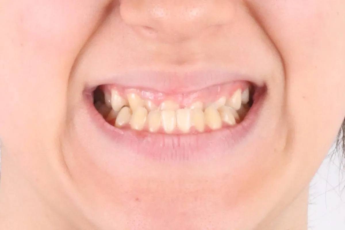 Front teeth in crossbite, corrected without surgery: smile before treatment
