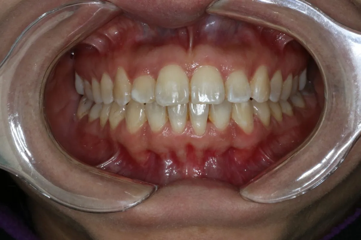 Single front tooth in crossbite: front view after treatment