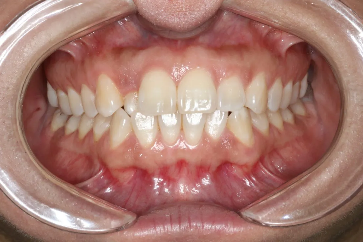 Single front tooth in crossbite: front view before treatment