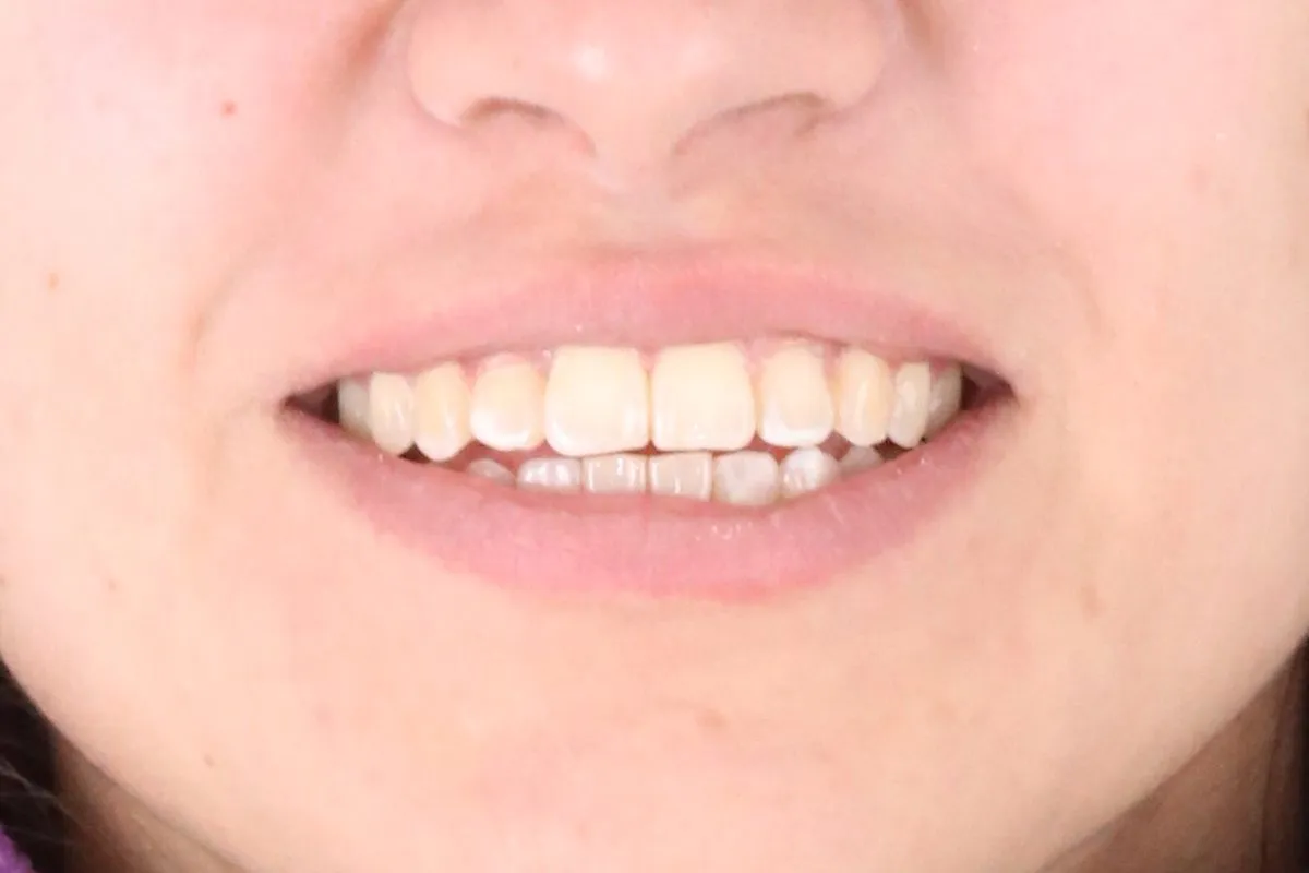 Single front tooth in crossbite: smile after treatment