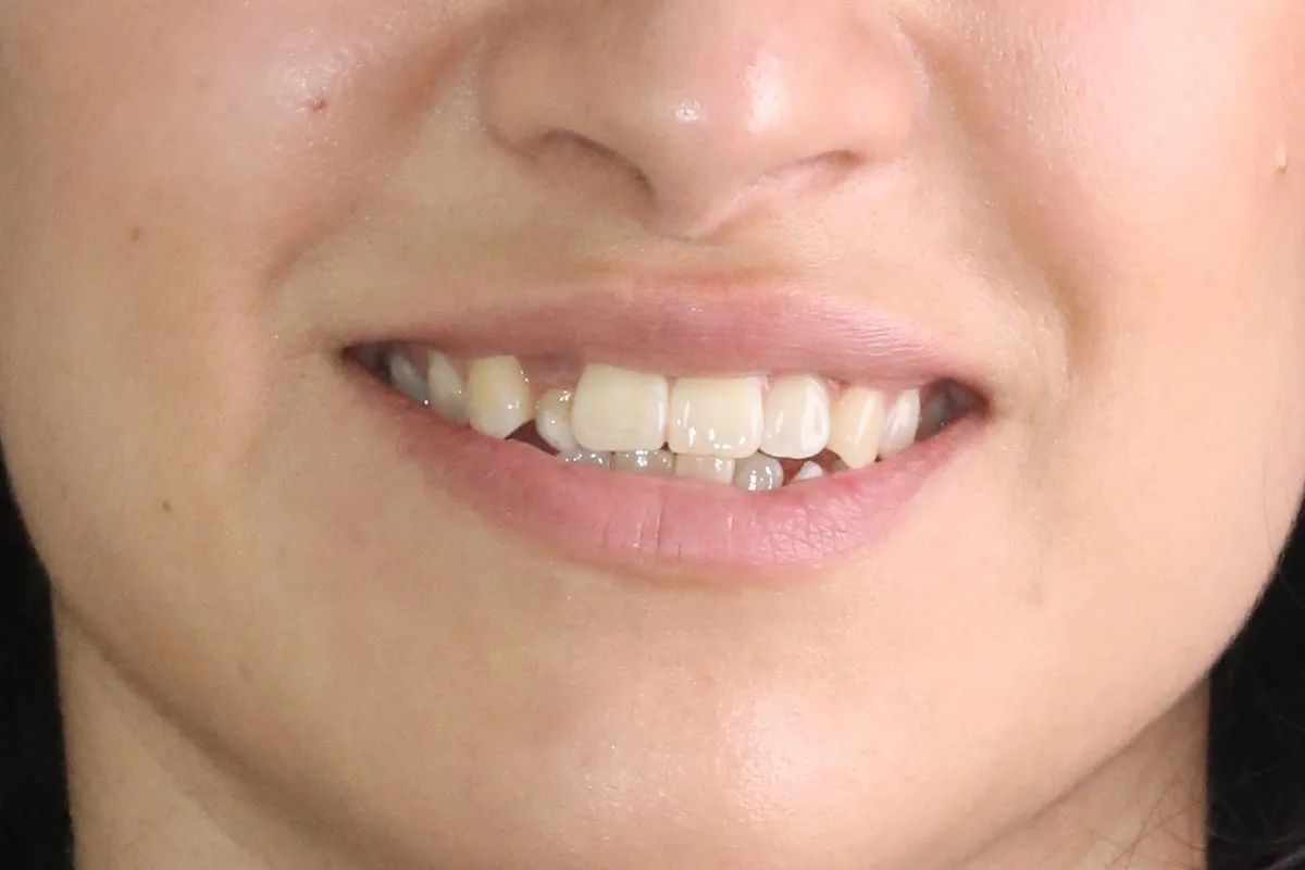 Single front tooth in crossbite: smile before treatment