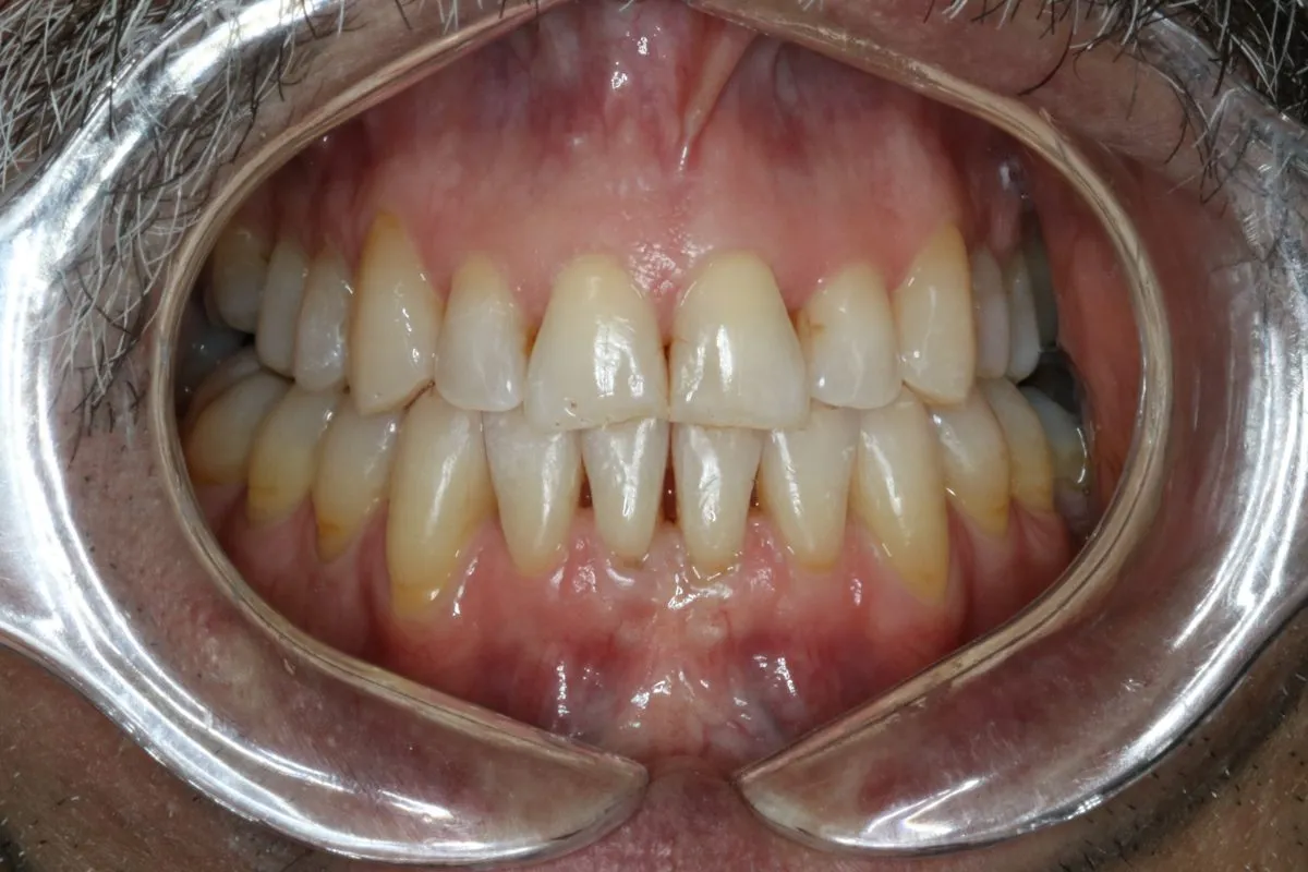 Adult crowding: front view after treatment