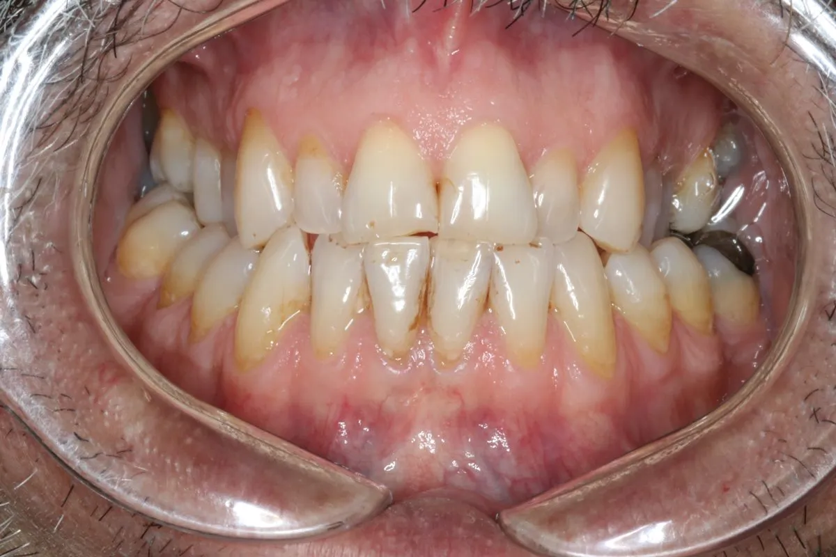Adult crowding: front view before treatment