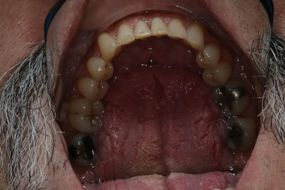 Adult crowding: lower arch after treatment