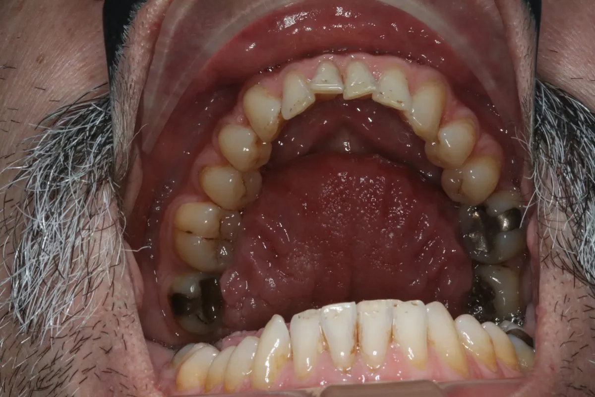 Adult crowding: lower arch before treatment