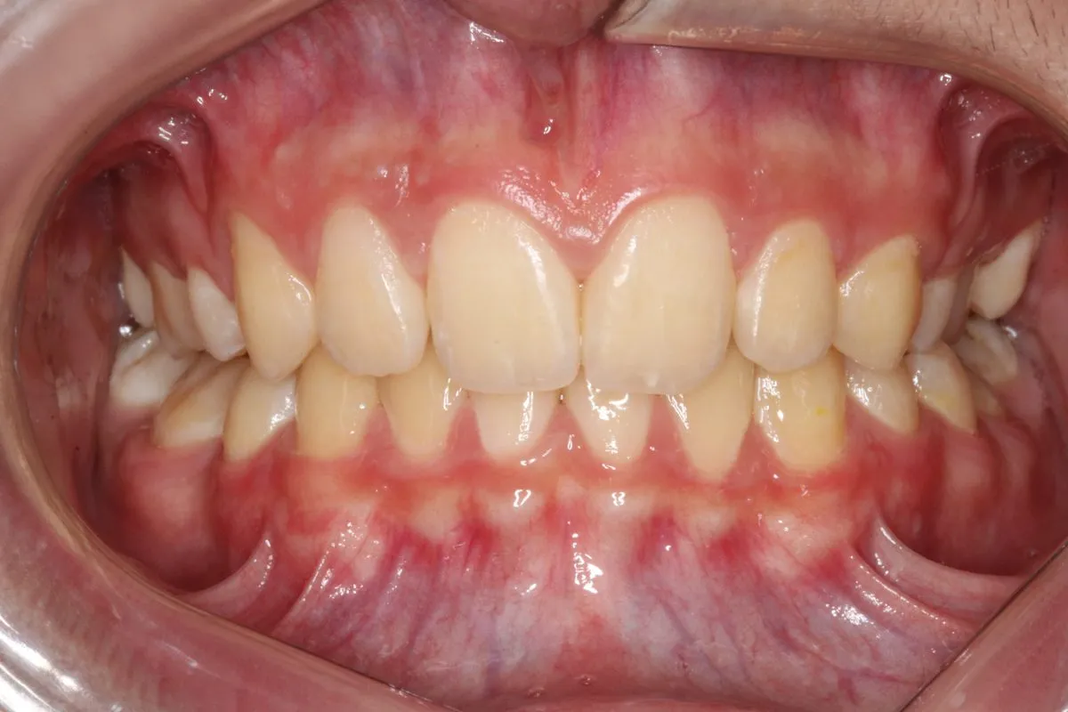 Child patient: crowding: front view after treatment