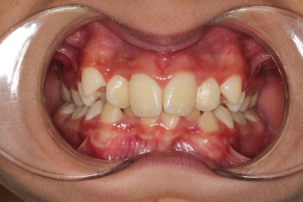 Child patient: crowding: front view before treatment