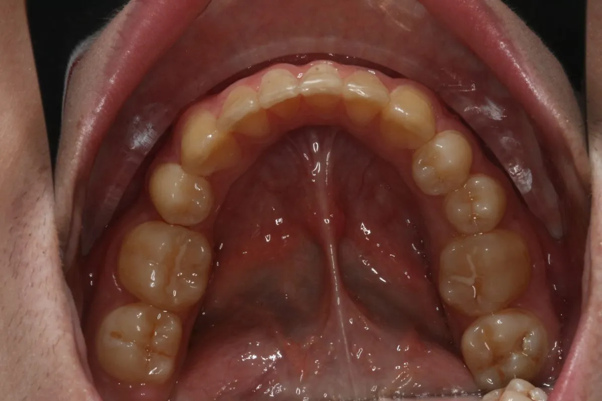Child patient: crowding: upper arch after treatment