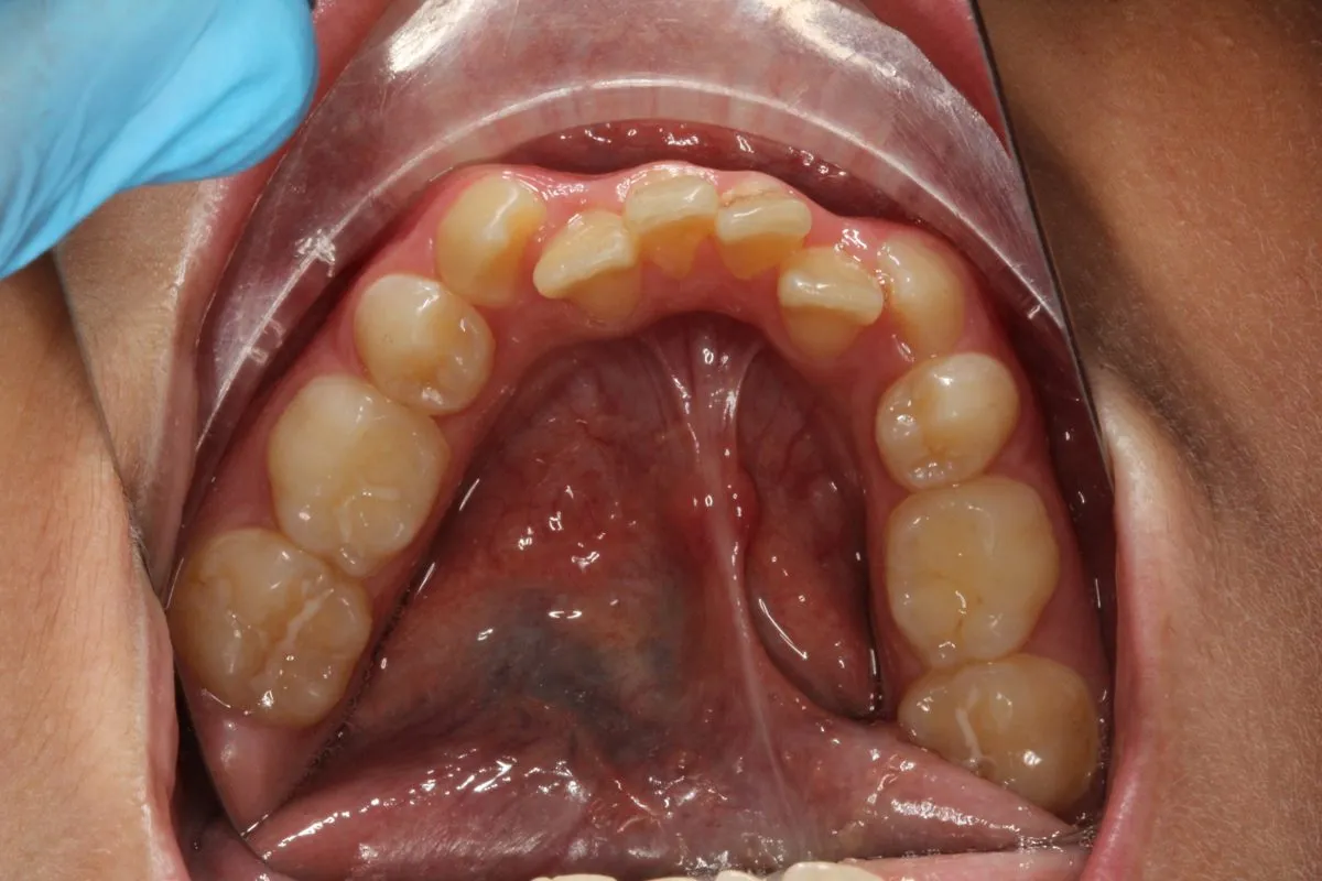 Child patient: crowding: upper arch before treatment