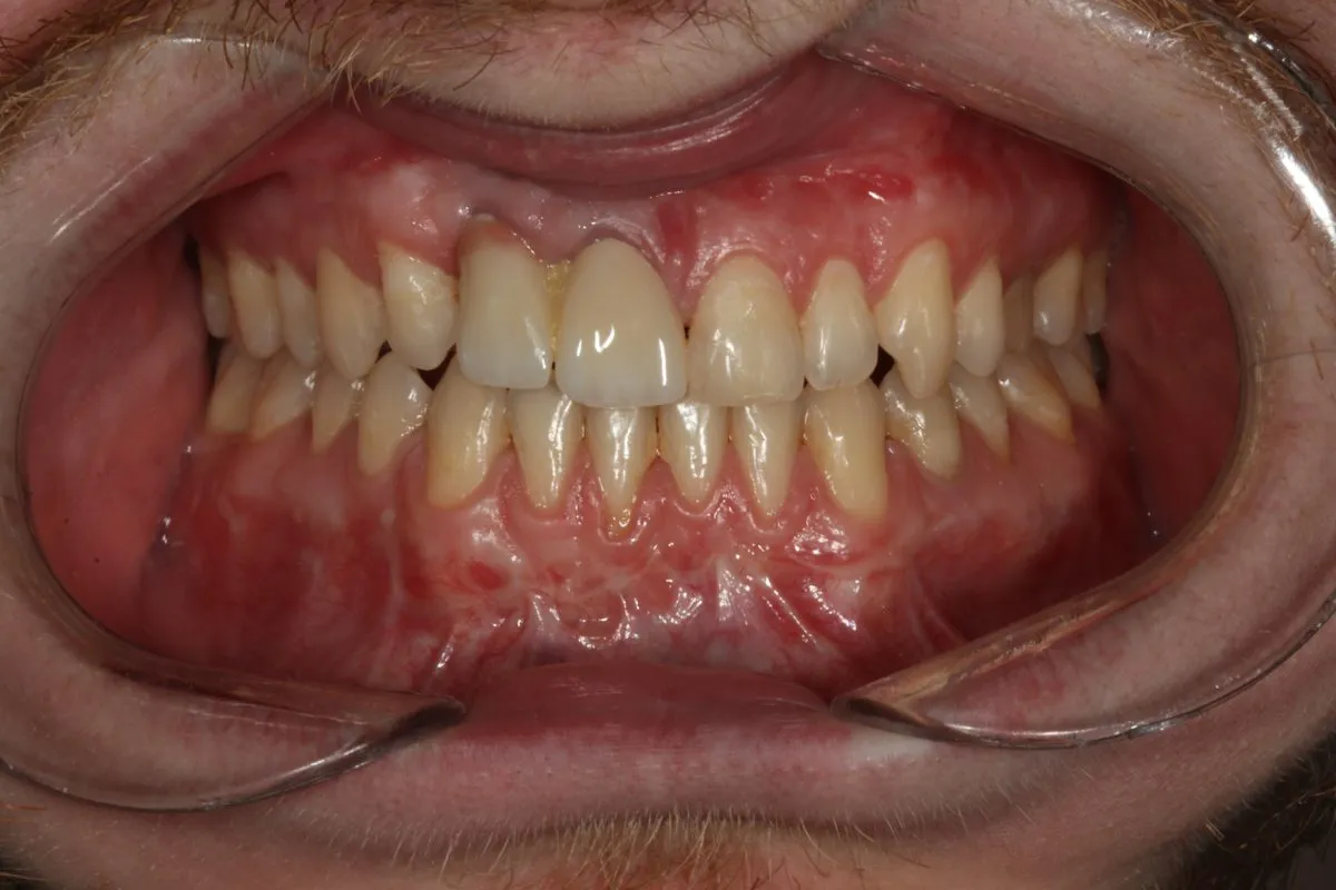 Complex case: orthodontics with jaw surgery and prosthetics: front view after treatment