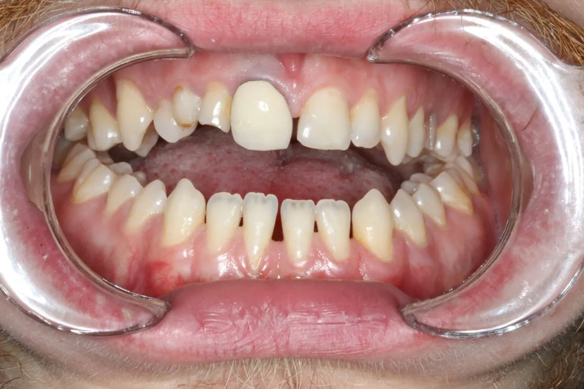Complex case: orthodontics with jaw surgery and prosthetics: front view before treatment