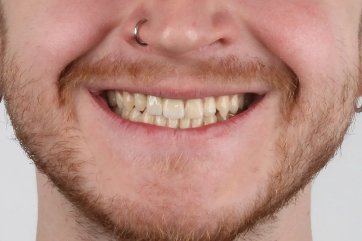 Complex case: orthodontics with jaw surgery and prosthetics: smile after treatment