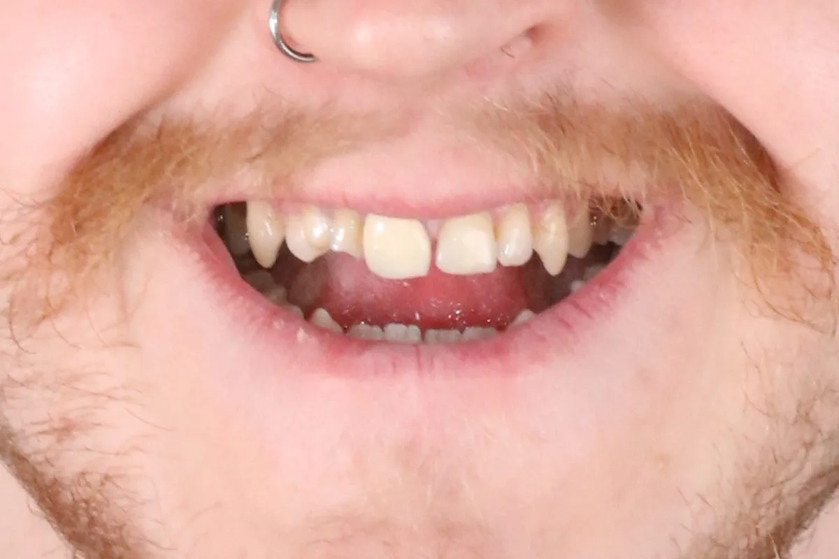 Complex case: orthodontics with jaw surgery and prosthetics: smile before treatment
