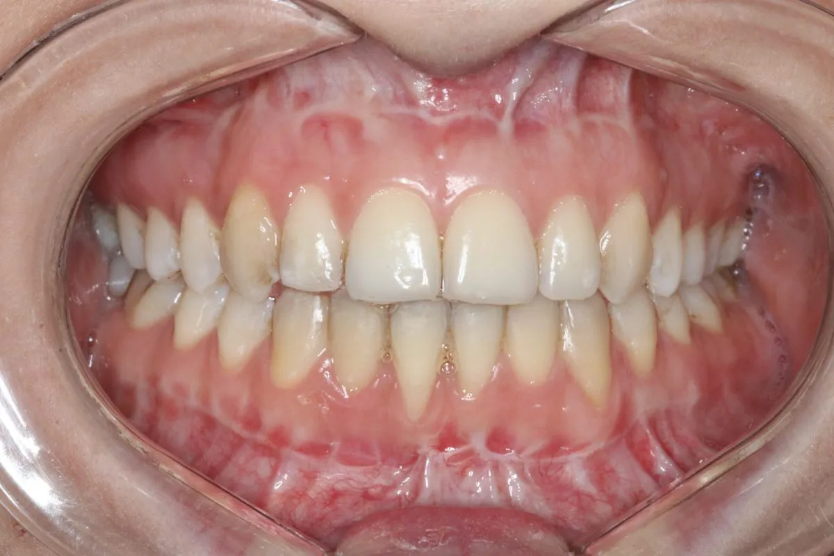 Skeletal bite problem: braces with jaw surgery: front view after treatment
