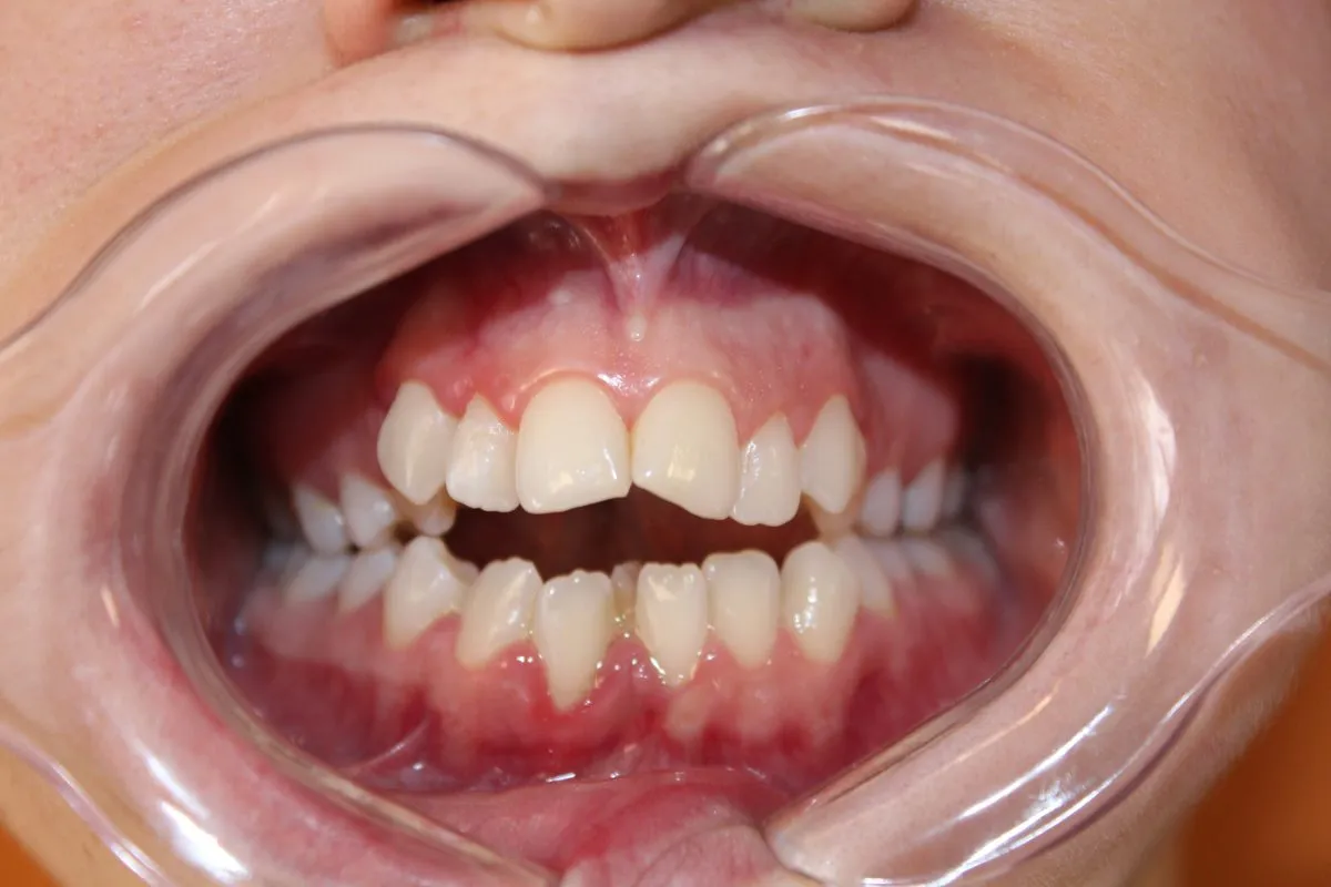 Skeletal bite problem: braces with jaw surgery: front view before treatment