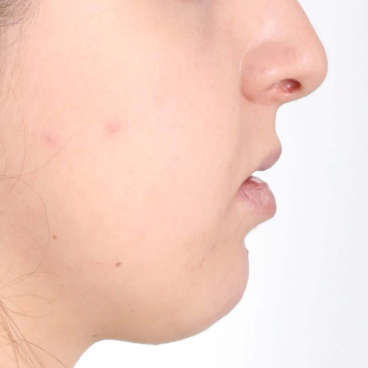 Skeletal bite problem: braces with jaw surgery: profile after treatment