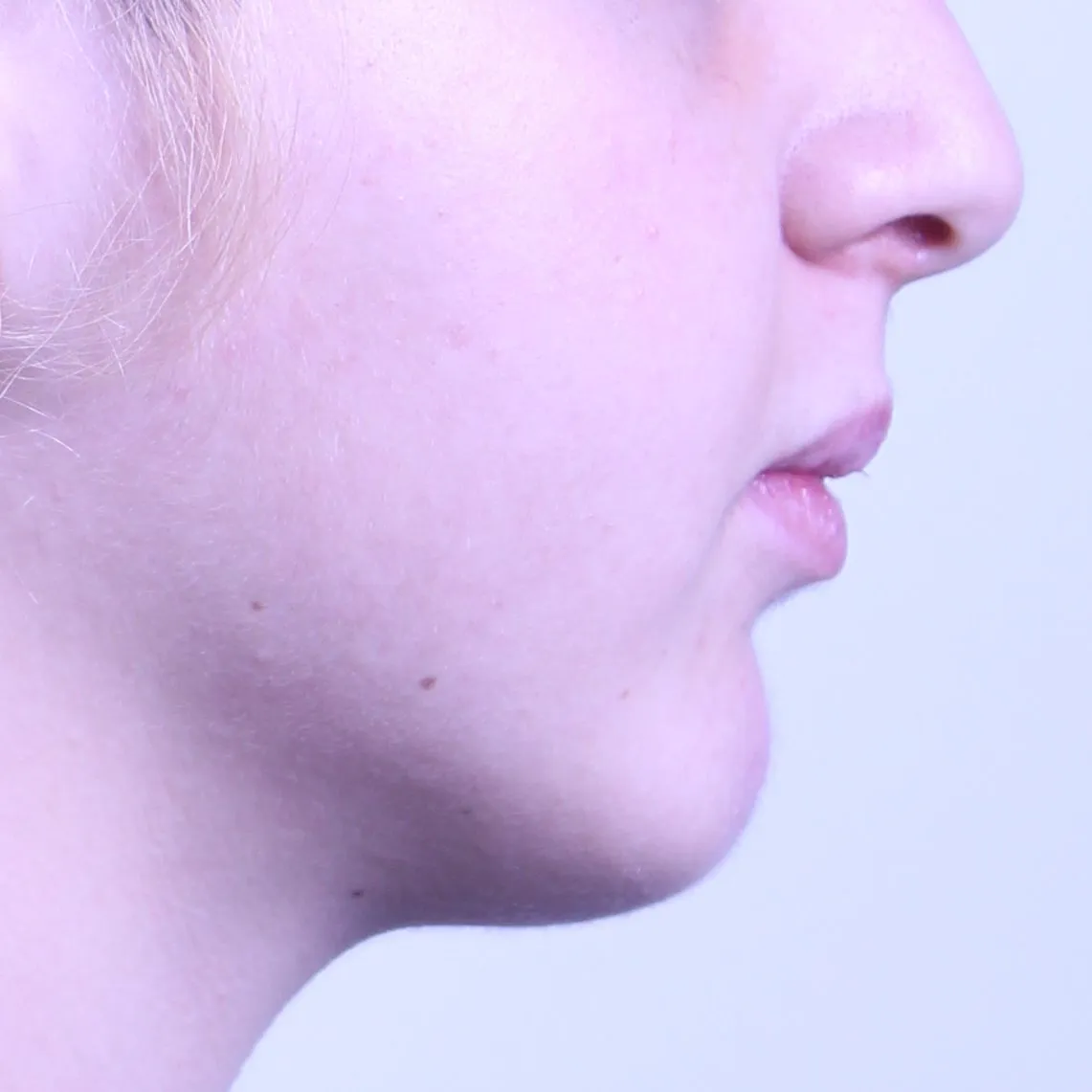 Skeletal bite problem: braces with jaw surgery: profile before treatment